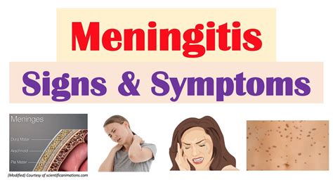 bacterial meningitis symptoms in women